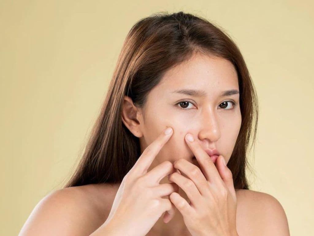 TIPS MENGHILANGKAN BEKAS JERAWAT YANG MENGHITAM